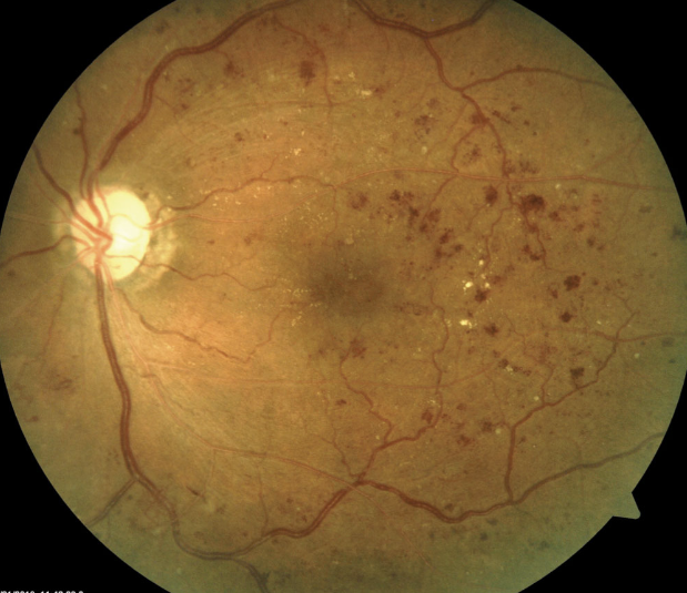 Diabetic retinopathy