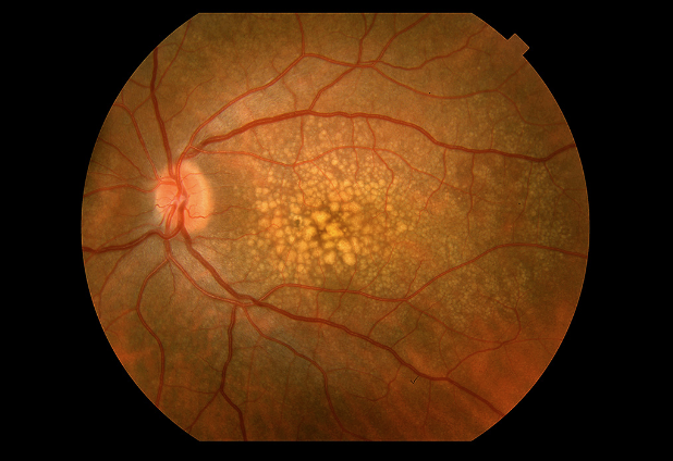 Diabetic retinopathy